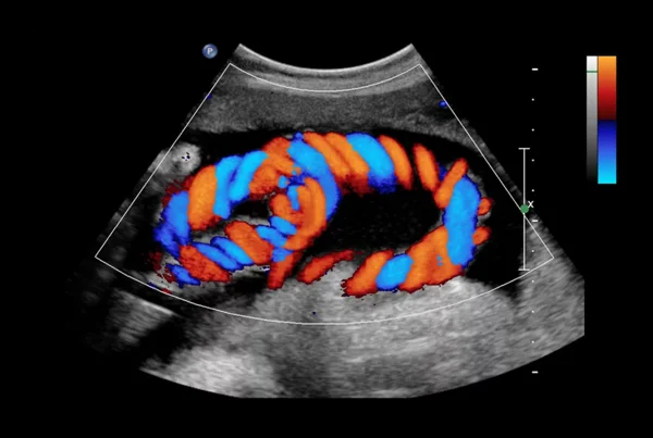Scrotal Doppler Test