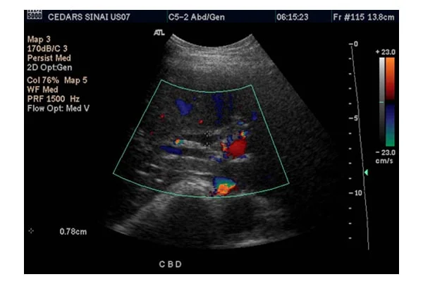 Whole Abdomen Ultrasound