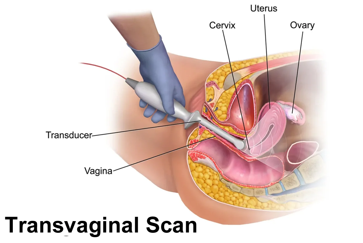 Transvaginal Sonography