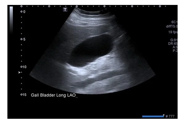 KUB Prostate Ultrasound